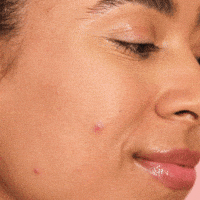 Acne Patch