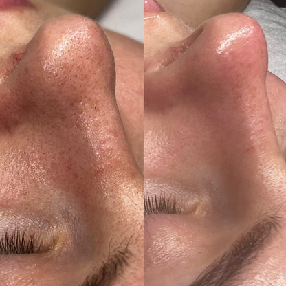 Filter Skin Instant (pores et cicatrice)